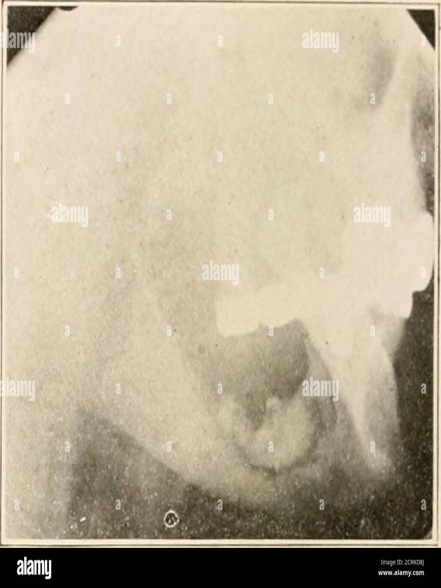 Sintético 94+ Foto pus en el labio inferior de la boca Lleno